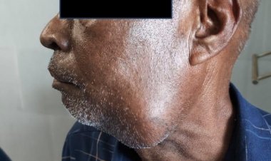 कैंसर के चौथे स्टेज पर था बुजुर्ग,  सिम्स के चिकित्सकों ने दिया नया जीवन