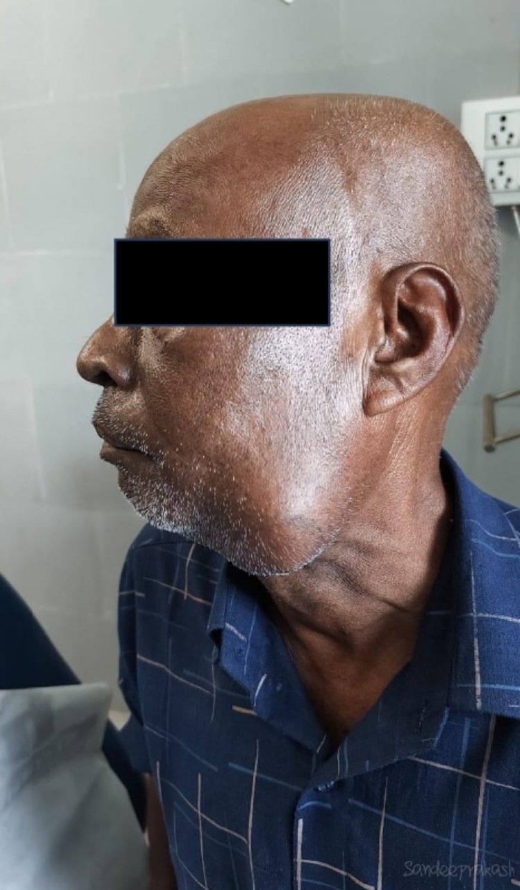 कैंसर के चौथे स्टेज पर था बुजुर्ग,  सिम्स के चिकित्सकों ने दिया नया जीवन