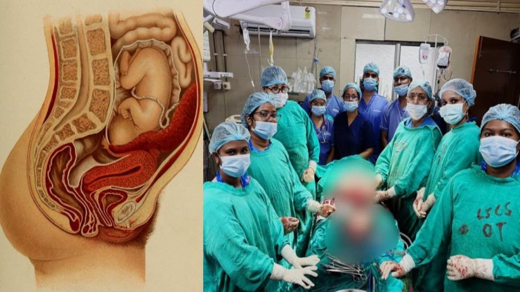 छत्तीसगढ़ का पहला मामला : मेकाहारा में दुर्लभ प्रेग्नेंसी का सफल ऑपरेशन, गर्भाशय में नहीं पेट में पला भ्रूण, मां और शिशु दोनों सुरक्षित